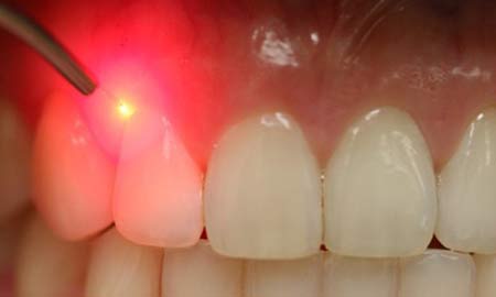 laser-dental
